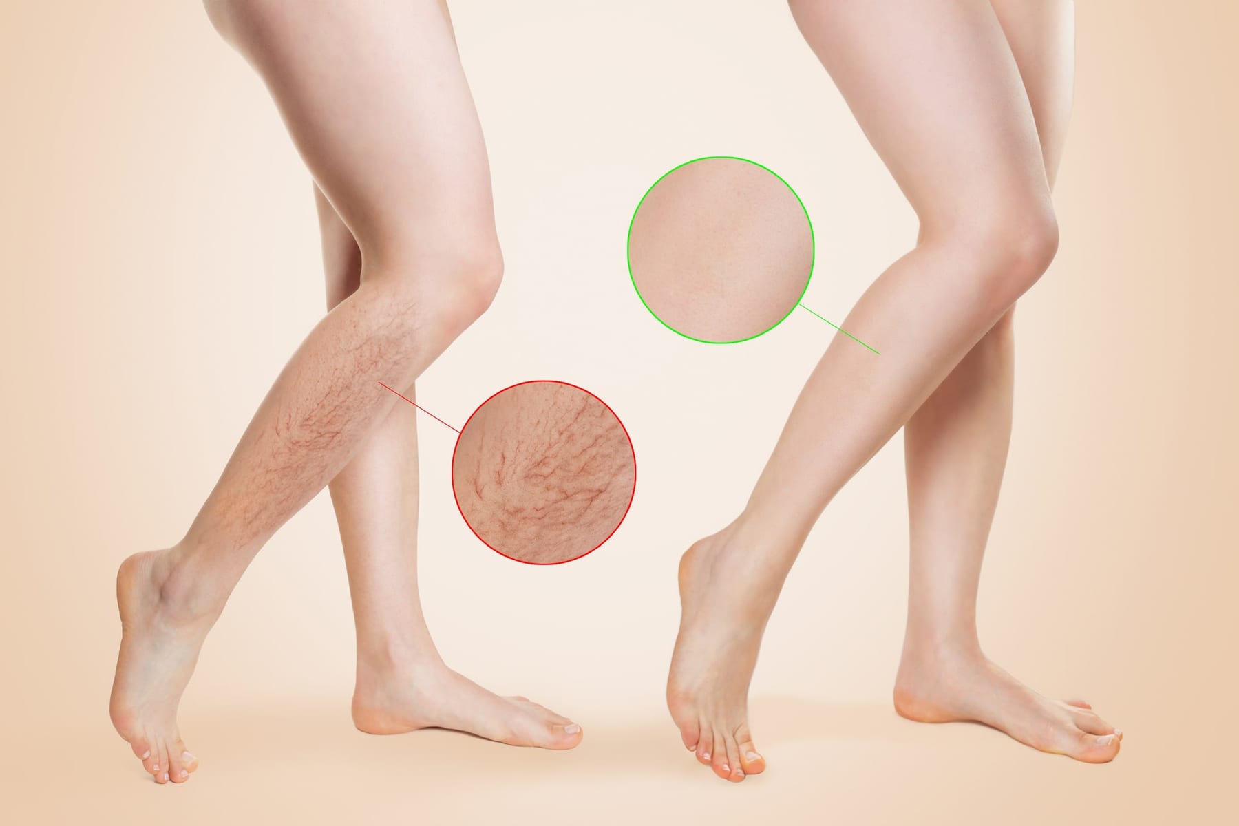 Varicose and Spider Vein Treatment